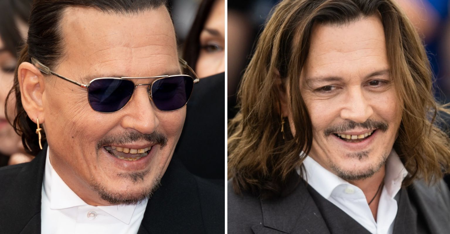 Johnny Depp Teeth Before and After